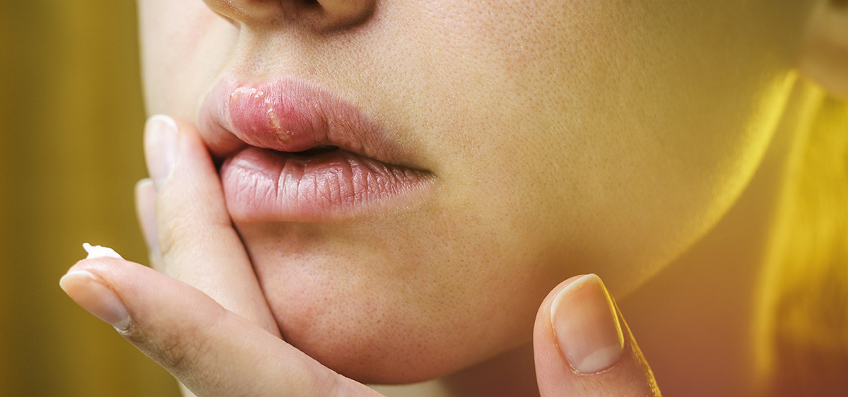 Herpès : Vrai / Faux sur les idées reçues